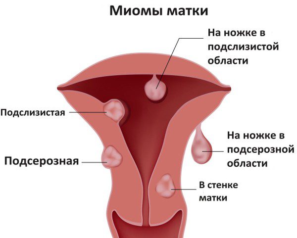 Разновидности миомы матки