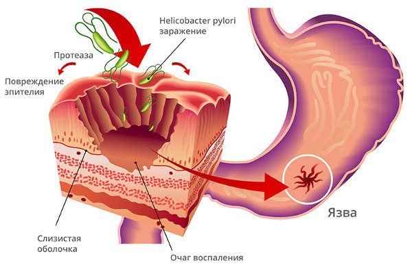 Схематичное изображение эрозии желудка