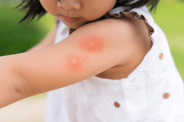Почему зудит комариный укус